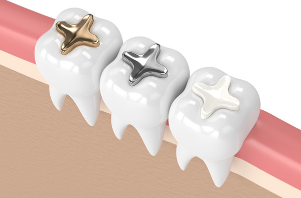 Rendering of teeth with 3 filling materials.